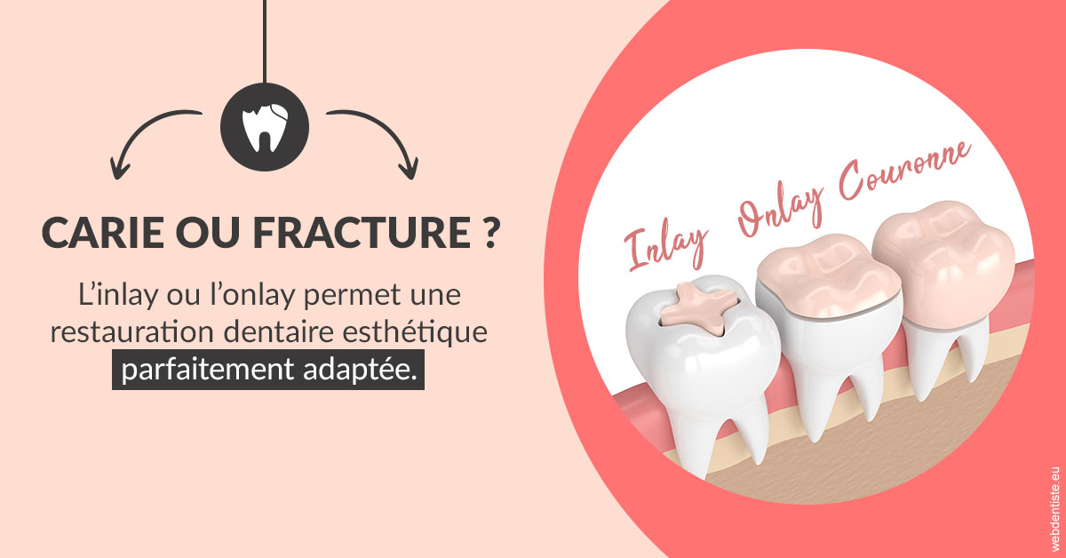 https://dr-surmenian-jerome.chirurgiens-dentistes.fr/T2 2023 - Carie ou fracture 2