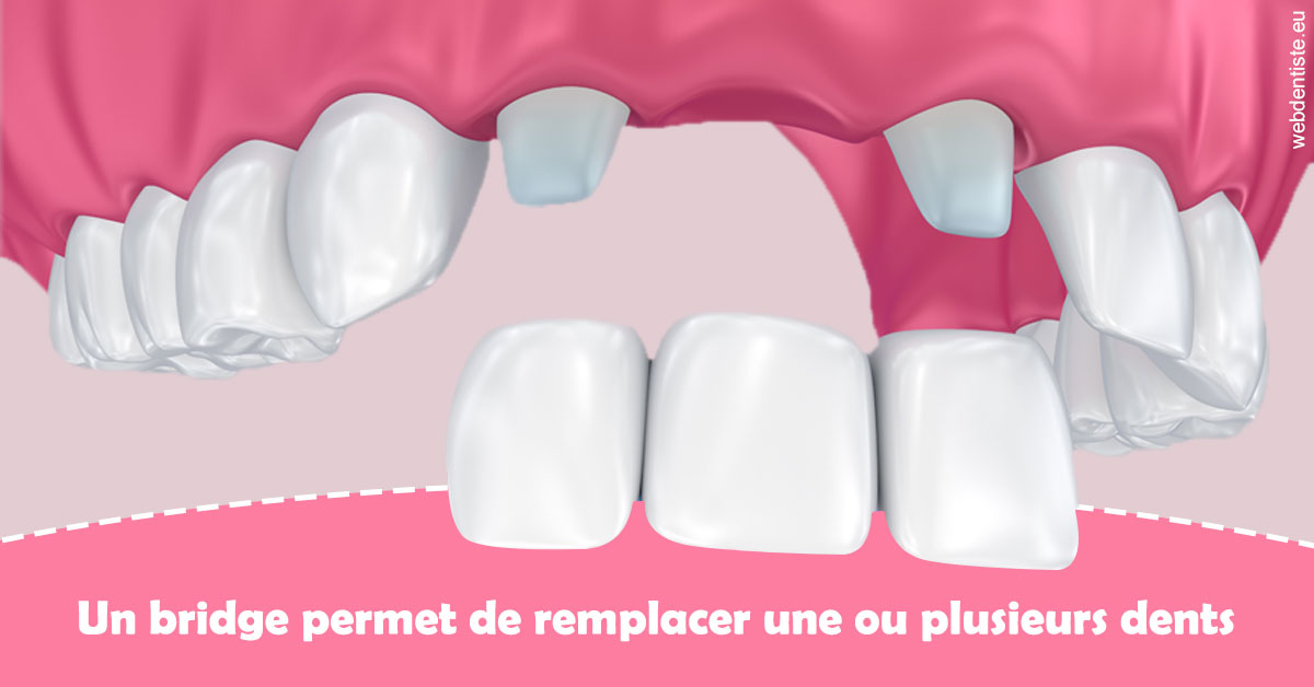 https://dr-surmenian-jerome.chirurgiens-dentistes.fr/Bridge remplacer dents 2