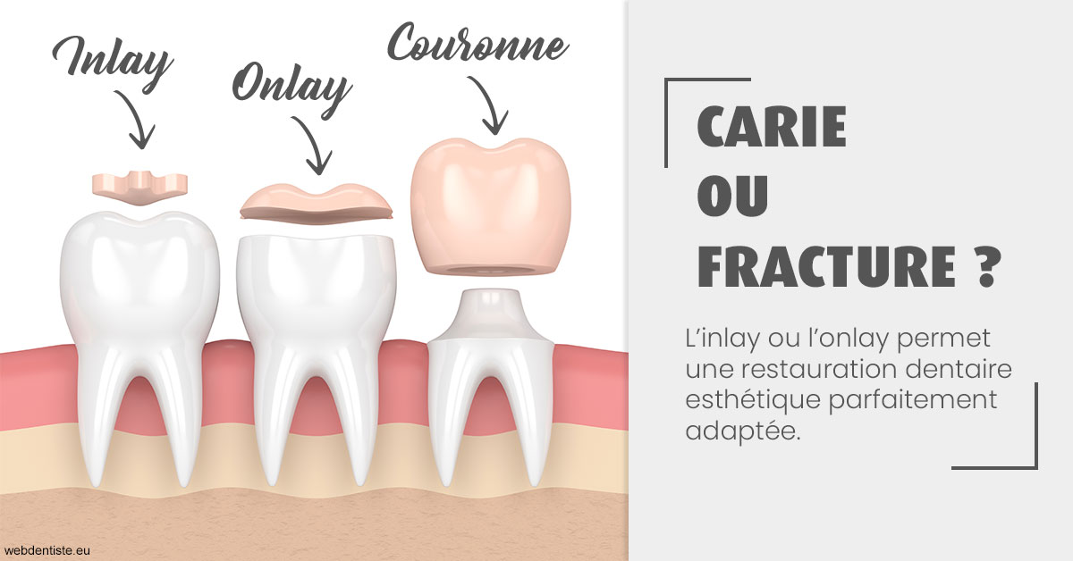 https://dr-surmenian-jerome.chirurgiens-dentistes.fr/T2 2023 - Carie ou fracture 1