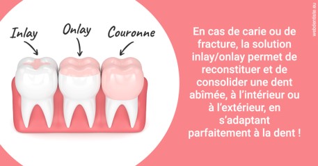 https://dr-surmenian-jerome.chirurgiens-dentistes.fr/L'INLAY ou l'ONLAY 2