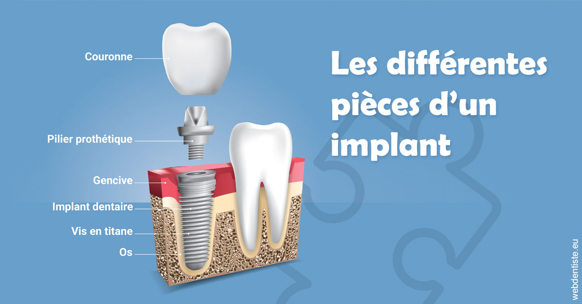 https://dr-surmenian-jerome.chirurgiens-dentistes.fr/Les différentes pièces d’un implant 1